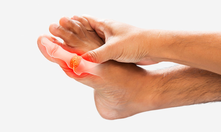 Ayurveda treatment for gout
