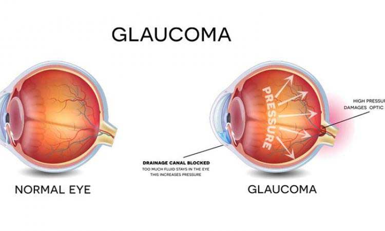 Glaucoma