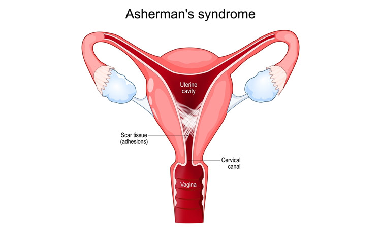 Dysfunctional / Abnormal Uterine Bleeding
