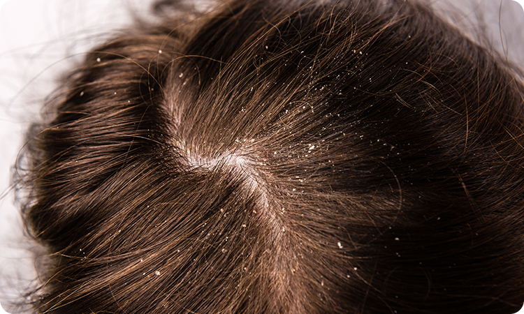 Dandruff